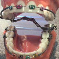 thumb-trmnt-braces-emergency-01