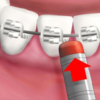 thumb-trmnt-braces-emergency-02