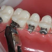thumb-trmnt-braces-emergency-04