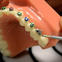 thumb-trmnt-braces-emergency-05