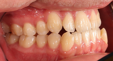 CLASS 3 EXT- 1 BEFORE