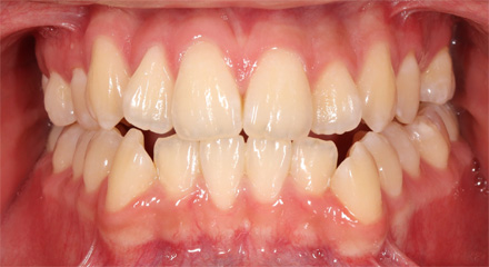 CLASS 3 EXT- 2 BEFORE