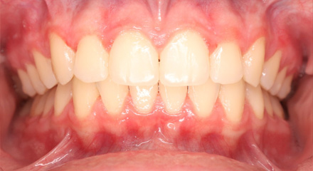DEEP BITE CLASS 2 - 1 - AFTER