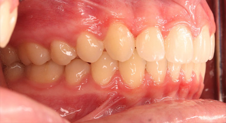 DEEP BITE CLASS 2 - 2 - AFTER