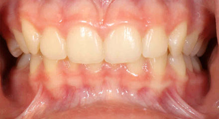 DEEP BITE CLASS 2 - 1 - BEFORE