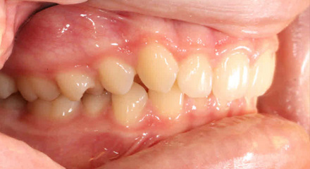 DEEP BITE CLASS 2 - 2 - BEFORE