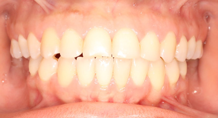OPEN BITE AFTER