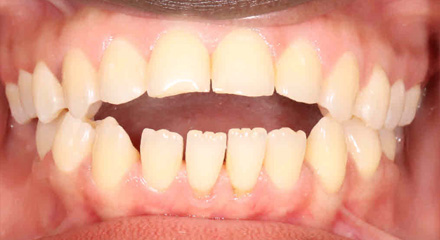 OPEN BITE BEFORE