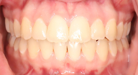 PHASE 2 OPEN BITE AFTER