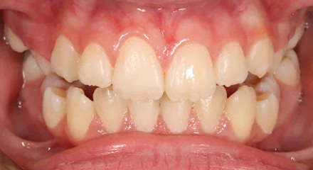 PHASE 1 OPEN BITE AFTER
