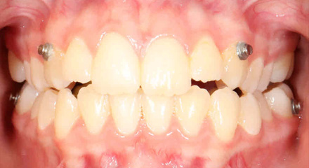 PHASE 2 OPEN BITE BEFORE