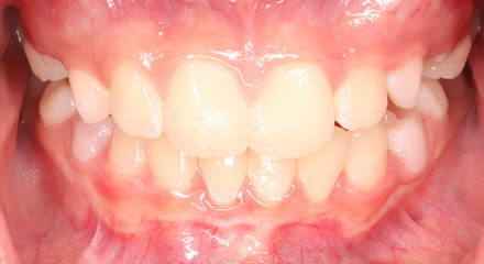 PHASE 1 LOWER GINGIVAL RECESSION AFTER