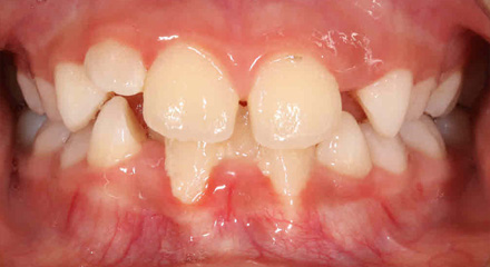 PHASE 1 LOWER GINGIVAL RECESSION BEFORE