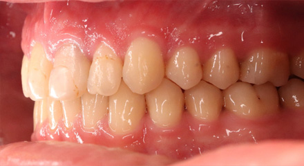 SEVERE OVERJET AFTER