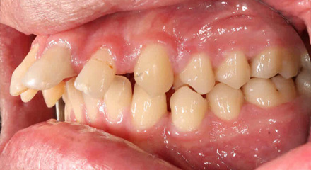 SEVERE OVERJET BEFORE